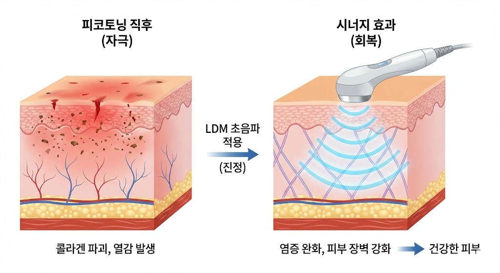 이미지 설명: 피코토닝 후 LDM 관리의 시너지 효과 다이어그램. 피코토닝으로 자극받은 피부(붉은색)에 LDM 초음파가 적용되어 염증이 완화되고(파란색), 피부 장벽이 탄탄하게 회복되는 과정을 시각화.
