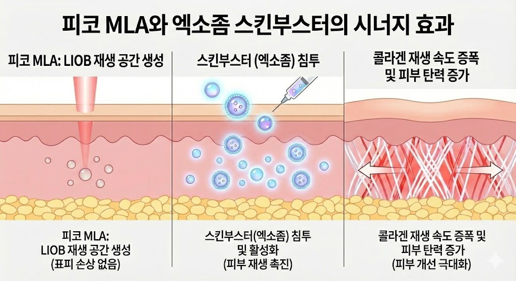 이미지 설명: 피코 MLA + 스킨부스터(엑소좀) 시너지 효과 다이어그램. 피코 MLA로 생성된 LIOB 공간에 엑소좀 성분이 침투하여 콜라겐 재생 속도가 증폭되는 과정을 시각화.