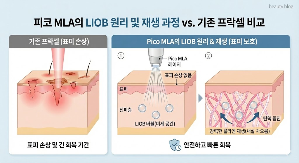 🖼️ [이미지 삽입 구간 3]  이미지 설명: 피코 MLA의 LIOB 원리 및 재생 과정 다이어그램.  (1) 레이저가 표피를 통과하여 진피층에 LIOB 버블 형성 (표피 손상 없음 강조).  (2) LIOB 주변으로 강력한 콜라겐 재생(새살 차오름)이 일어나는 모습 시각화.  기존 프락셀(이미지 1)과 대비하여 표피 손상이 없음을 명확히 보여줌.