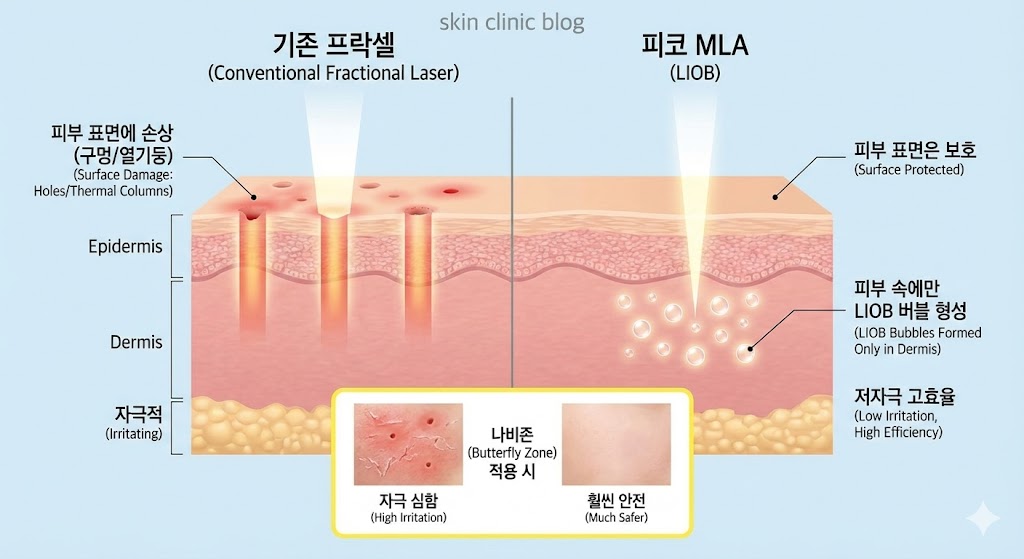 이미지 설명: 기존 프락셀 vs 피코 MLA(LIOB) 원리 비교 다이어그램.  (기존 프락셀): 피부 표면에 손상(구멍/열기둥)을 입히는 모습 (자극적).  (피코 MLA): 피부 표면은 보호되고 피부 속에만 LIOB 버블이 형성되는 모습 (저자극 고효율).나비존 피부에 적용했을 때 피코 MLA가 훨씬 안전함을 강조.