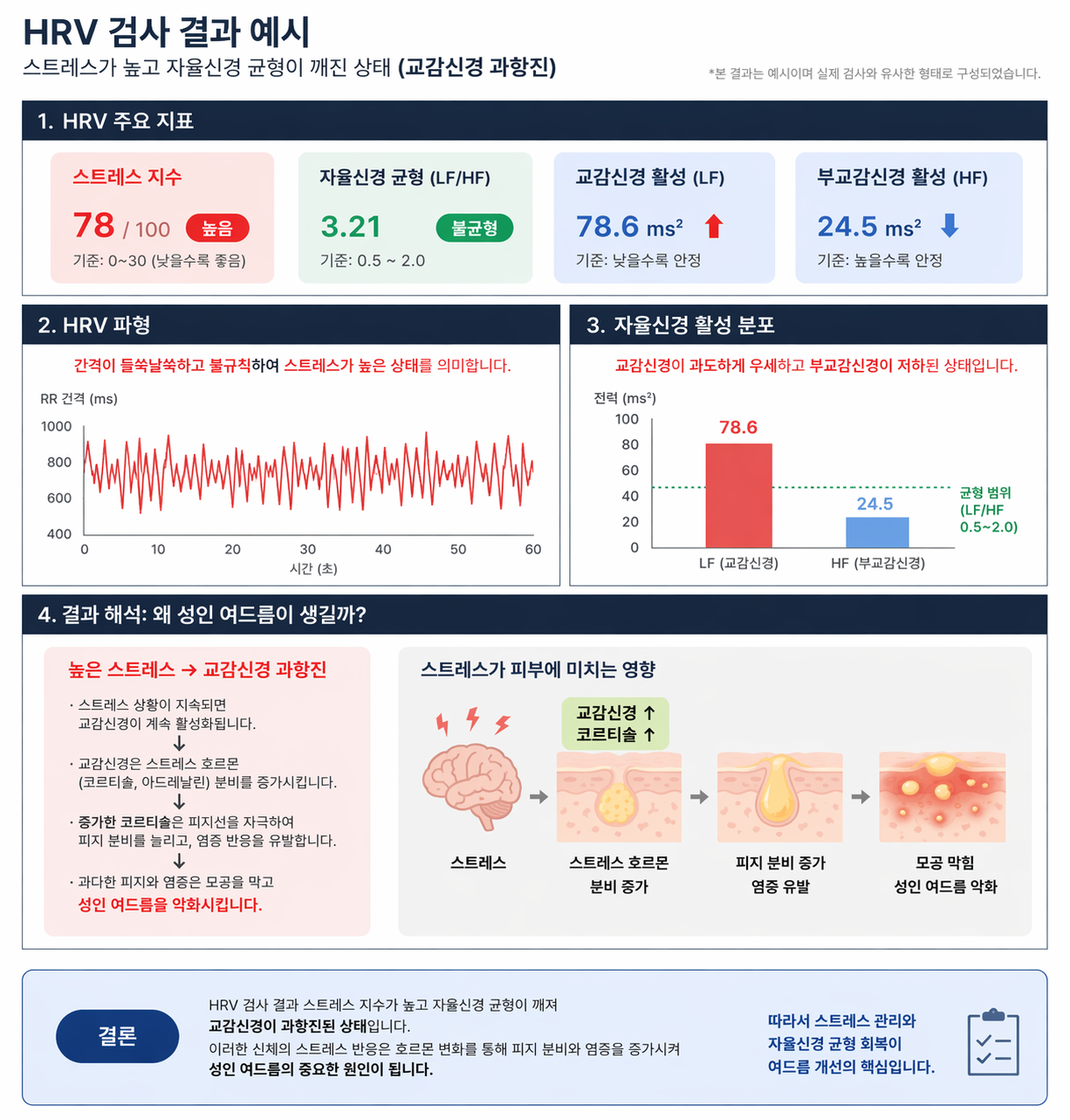 HRV 검사 결과 데이터 시각화 예시. 스트레스 지수가 높고 자율신경 균형이 깨진(교감신경 과항진) 그래프를 보여주며, 이것이 성인 여드름의 원인임을 설명.